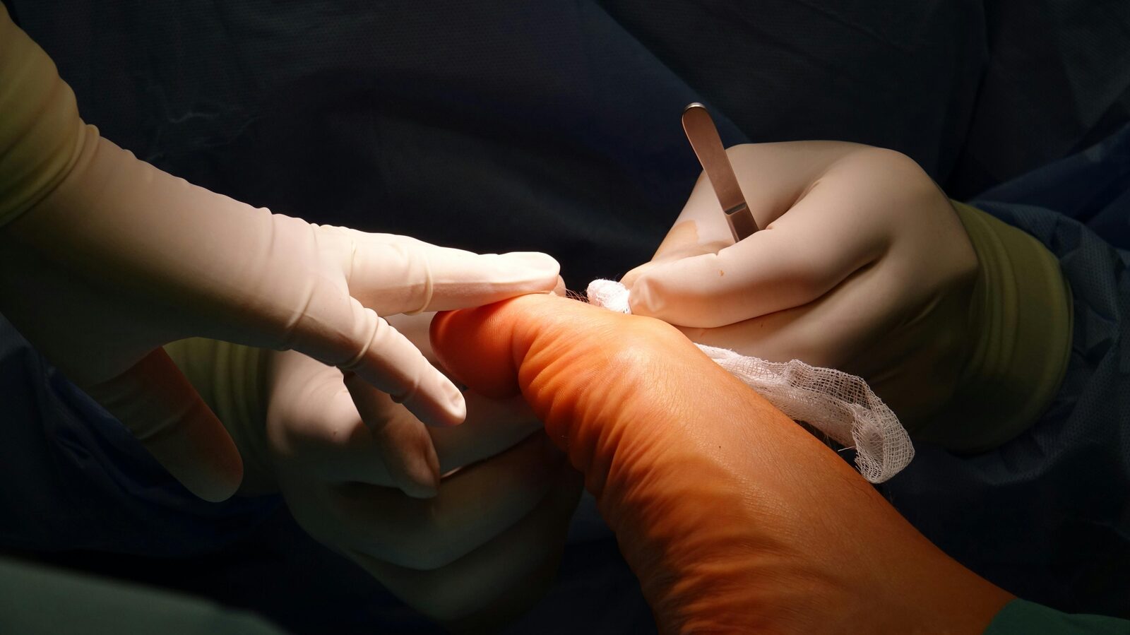 Corn removal treatment by chiropodist at Deal Podiatry in Deal, Kent